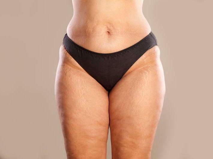 Eine Frau mit Lipödem an Bauch und Beinen