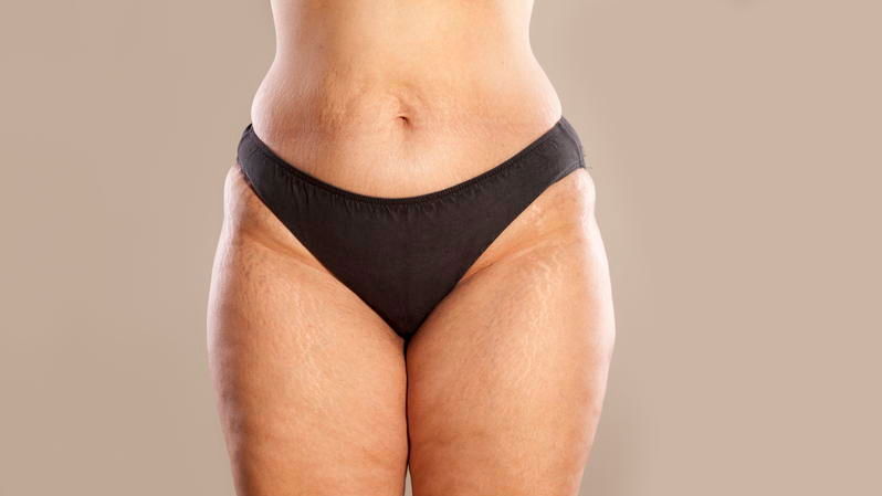 Liposuktion und mehr: Möglichkeiten zur Lipödem-Behandlung im Überblick